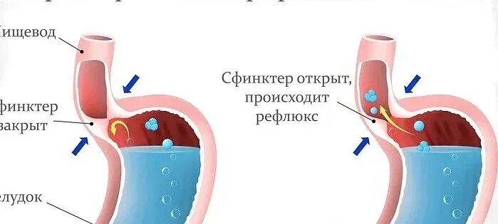 Дуоденогастральный рефлюкс желчи. Дуодено-гастральный рефлюкс 2ст. Дуодено-билиарный рефлюкс. Дуодено панкреатический рефлюкс. Заброс в пищевод симптомы и лечение