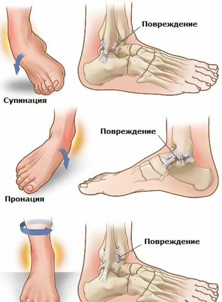 Как быстро сломать ногу