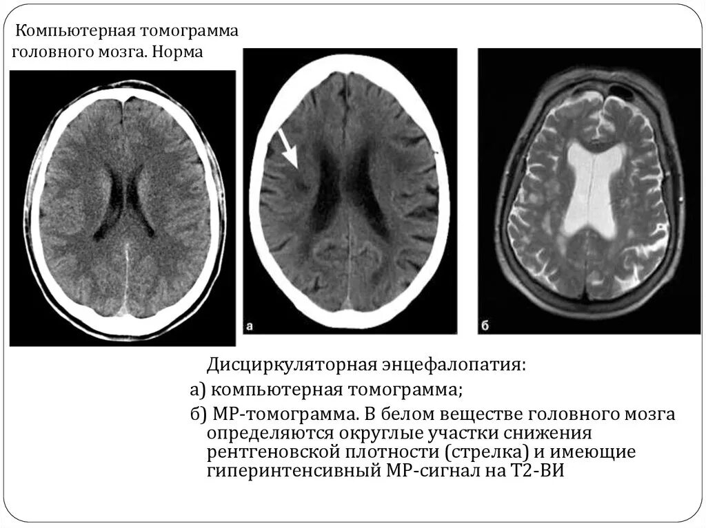 Постгипоксические изменения головного. Дисциркуляторная энцефалопатия головного мозга на кт. Дисциркуляторная энцефалопатия мрт. Гипертоническая дисциркуляторная энцефалопатия. Энцефалопатия головного мозга на кт.