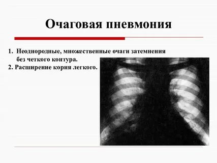 Четкие контуры очага в легком