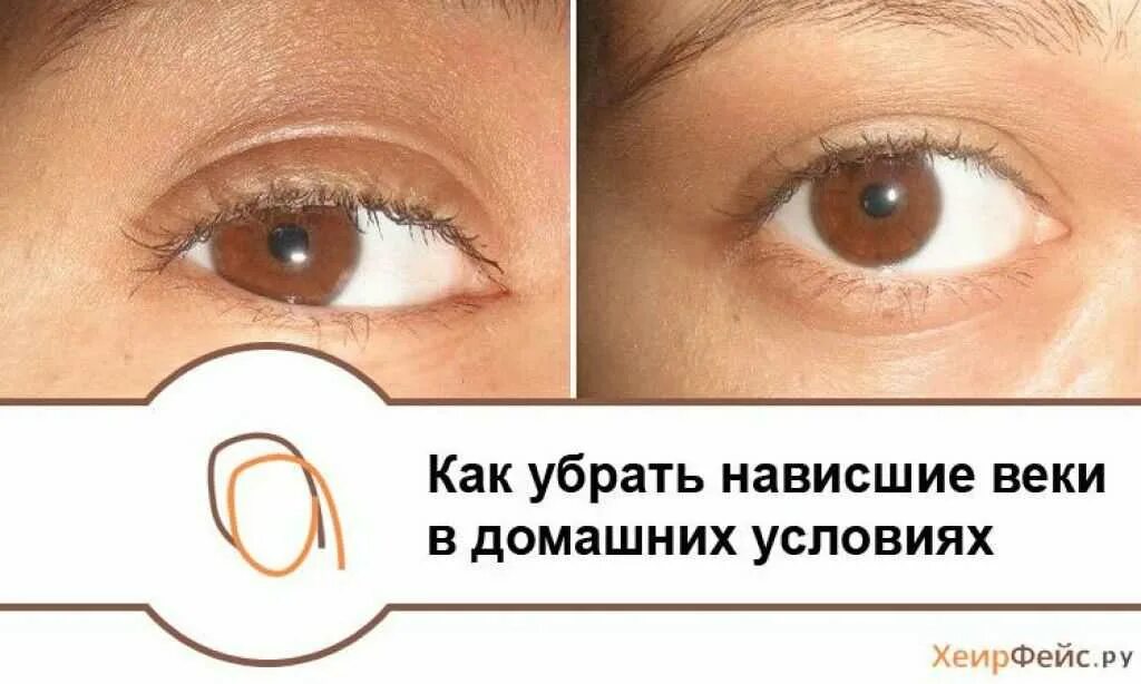 Как подтянуть веки глаз. Как убрать нависшего века. как убрать нависшее веко. нависание век над глазами. веко над глазом нависает.