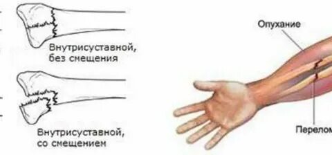 Как снять после лучевой отек