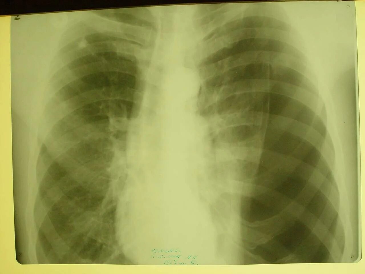 Остеопороз ключицы. Перелом ребра снимок рентген. Неконсолидированный перелом 10 ребра. Может ли быть вывих ребра. Трещина в ребре какие симптомы.