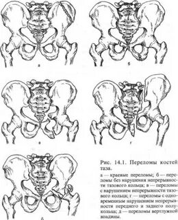 Перелом лобковой кости у женщин пожилого