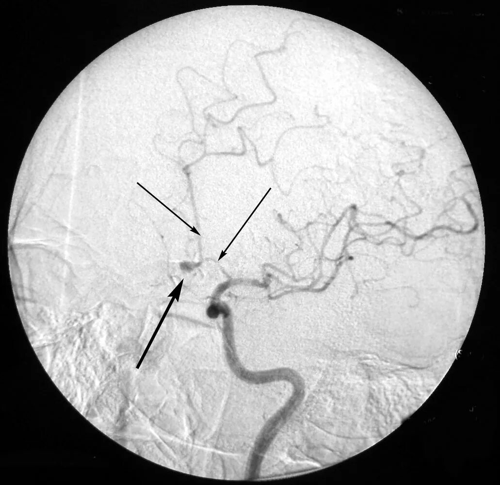 Расслаивающая аневризма головного мозга. Ангиография аневризма. Церебральная аневризма головного мозга это. Аневризма в переднемозговой артерии.