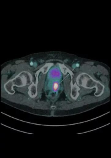 ПЭТ кт предстательной железы с ПСМА 68. Накопление 252 % РФП ПЭТ кт. Рфп при пэт кт