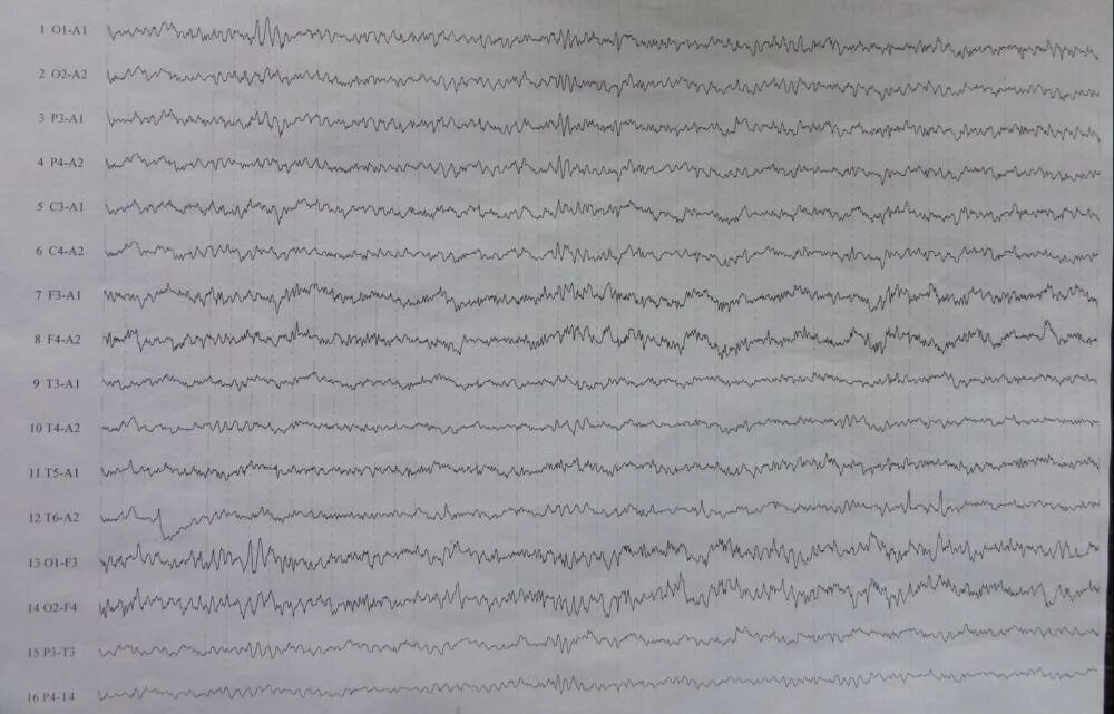 Здоровая ээг. PZ-a2 ЭЭГ. Пароксизмальная активность на ЭЭГ. ЭЭГ норма и патология. ЭЭГ пленка.