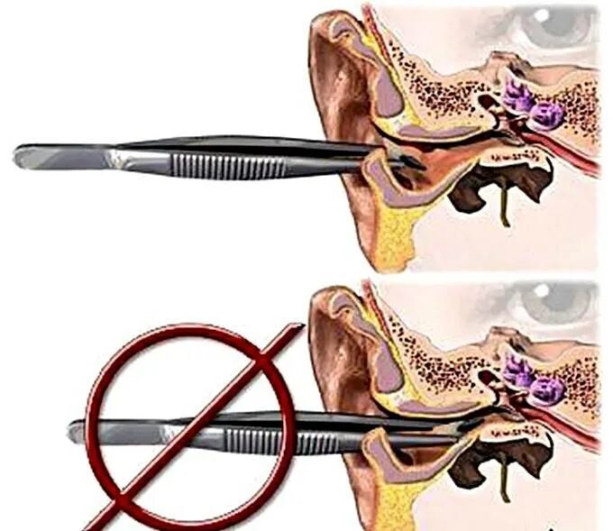 Почему возникает пробка в ухе. Инородное тело в узехе. Извлечение инородного тела из уха. Инородные тела наружного слухового прохода.
