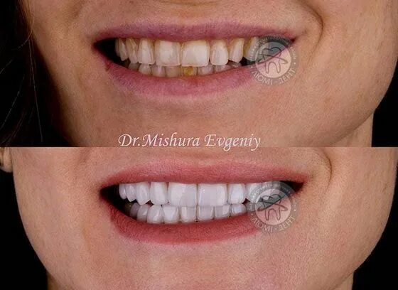 DENTIERA PROTESI DENTALE ARCATA SUPERIORE E INFERIORE REMOVIBILE DENTI FINTI eBa