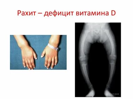 Дефицит д у детей