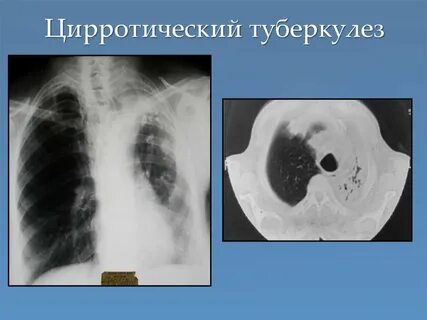 Цирроз легкого