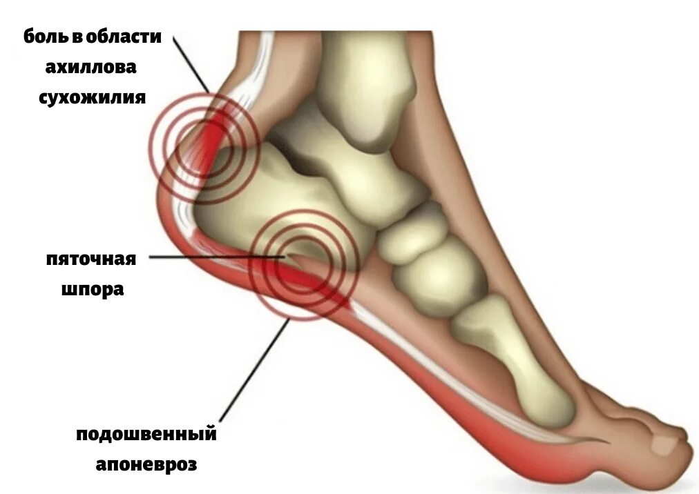 Со внутренней стороны. Плантарный фасциит стопы. Пяточная шпора плантарный фасциит. Плацентарный фасциит стопа. Подошвенный, или плантарный фасциит.