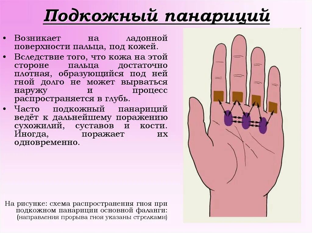 Имеет два развитых пальца. Клинические симптомы панариций.