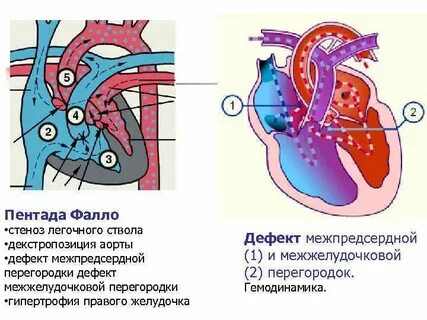 Дефект межжелудочковой перегородки клинические рекомендации