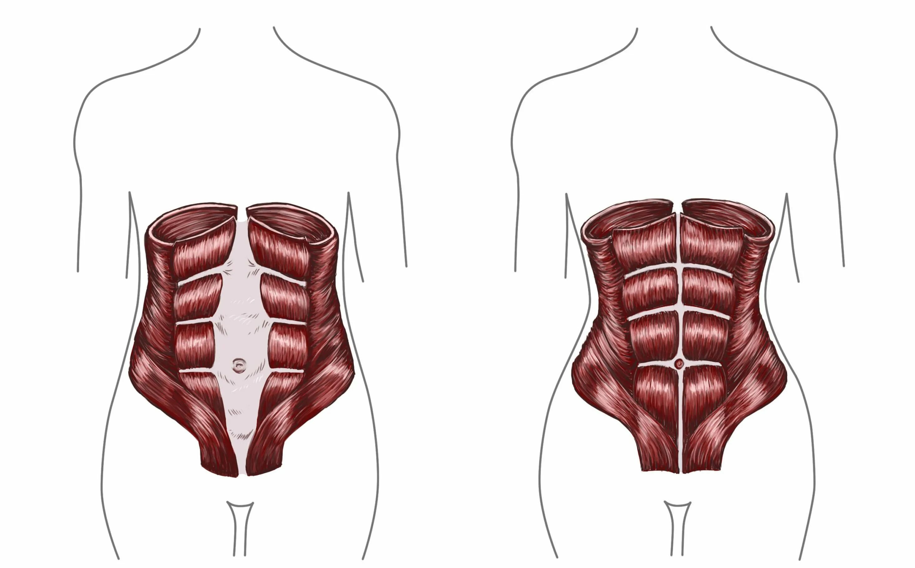 Прямая мышца живота у женщин. Диастаз прямой мышцы живота. Диастаз – расхождение прямых мышц живота. Диастаз мышц белой линии.