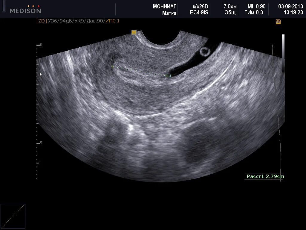 Эндометрий 9мм. Шеечная внематочная беременность УЗИ. Шеечная беременность УЗИ. Внематочная беременность снимки УЗИ. Внематочная беременность на УЗИ фото.