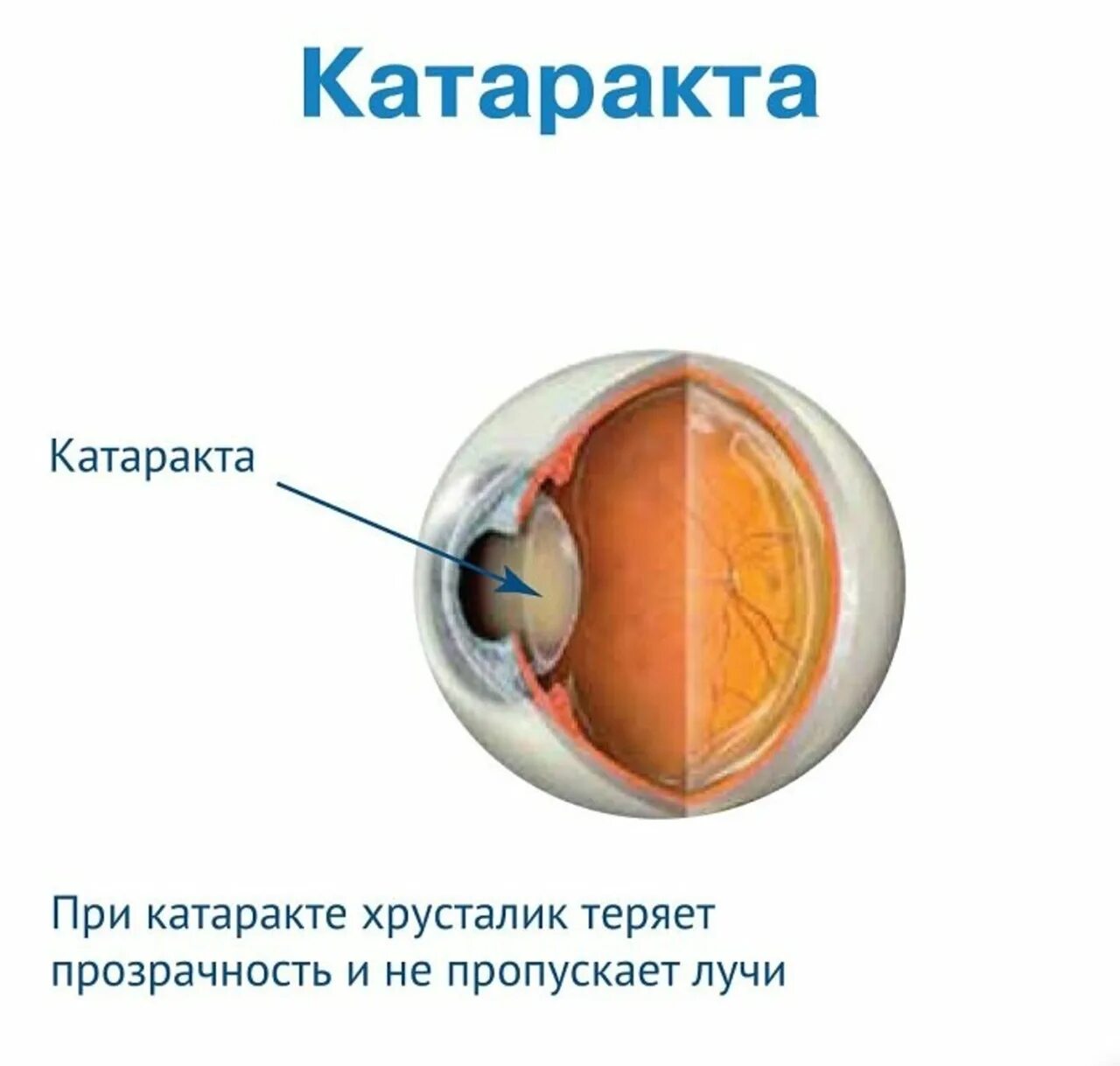 Факосклероз хрусталика что это такое