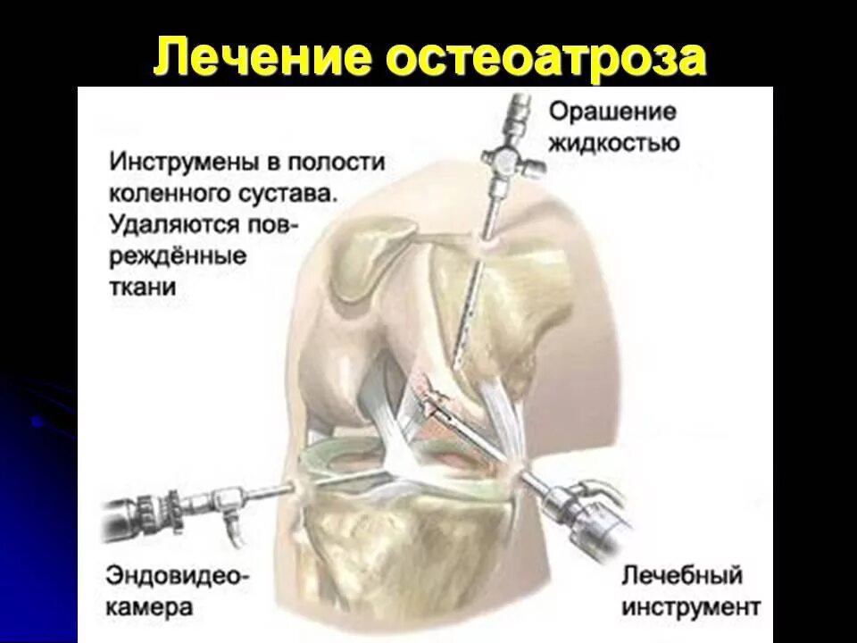 Операция на разрыв мениска артроскопия. Артроскопическая резекция медиального мениска. Артроскопический шов мениска ход операции. Артроскопия связок коленного сустава. Операции на коленном суставе стоимость