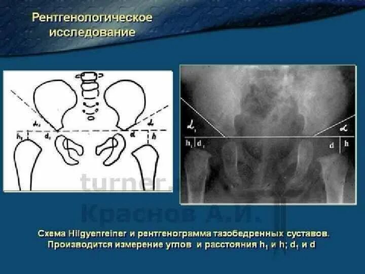 Тазобедренный сустав рентген норма. Рентген описание тазобедренного сустава. Тазобедренный сустав рентген норма описание. Врожденный вывих бедра рентген. Ацетабулярная дисплазия тазобедренных суставов мрт.