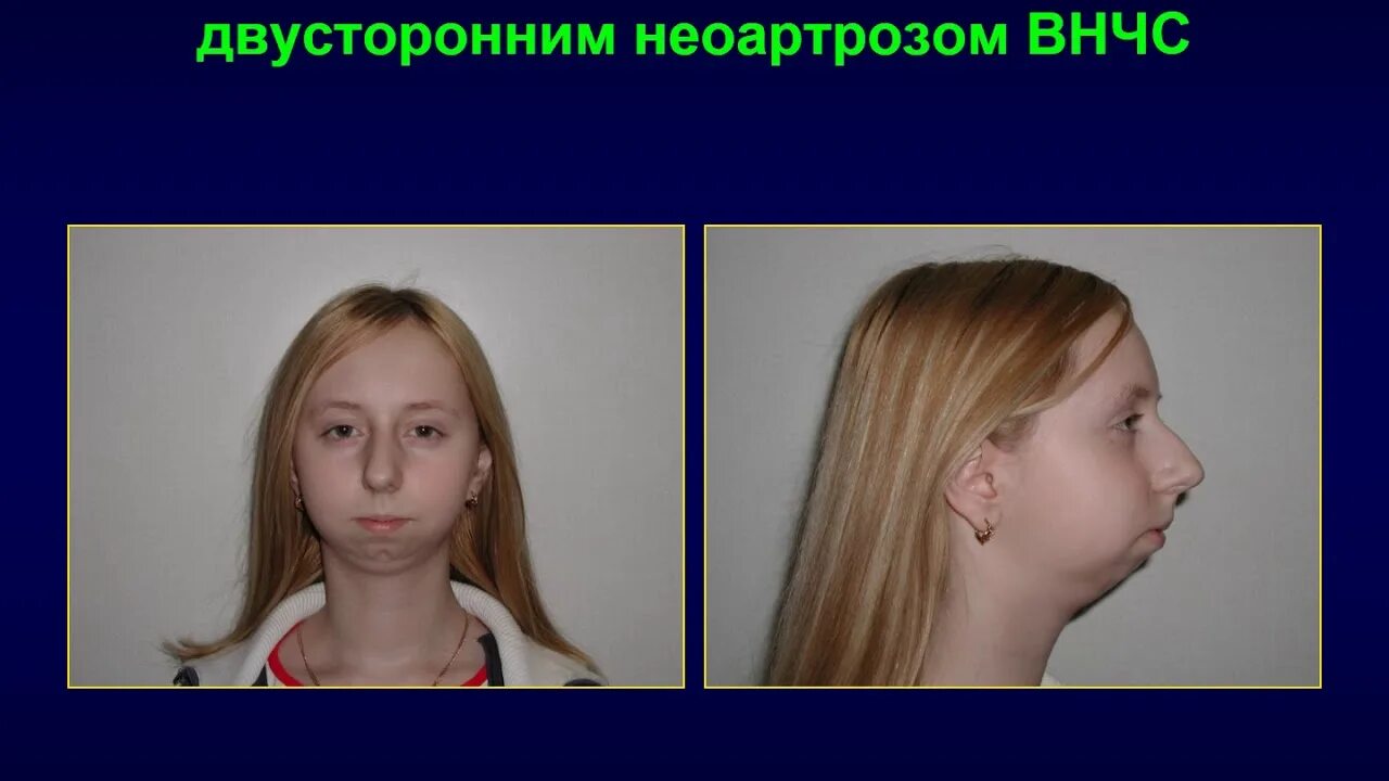 INTRAORAL DISTRACTION OSTEOGENESIS Pocket Dentistry