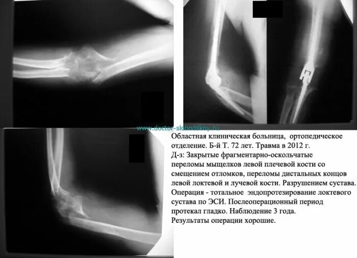 Как разрабатывать руку перелом локтевого сустава. Перелом мыщелка локтевого сустава рентген. перелом мыщелков плечевой кости рентген. перелом локтевого сустава рентген мыщелок. закрытый перелом мыщелка плечевой кости со смещением.