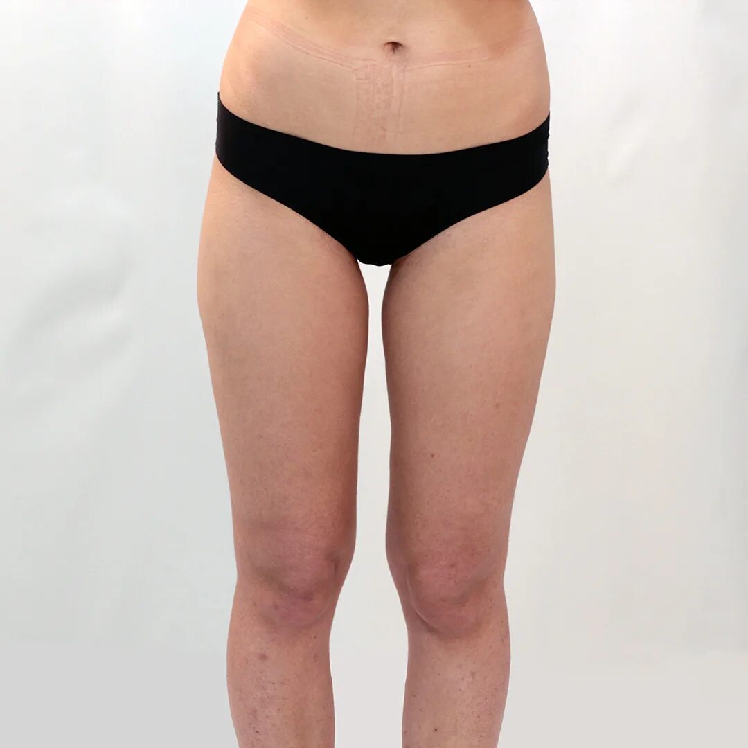 лазерная липосакция голеней. лазерная липосакция галифе. липосакция бедер ваш бренд тут. липосакция внутренней поверхности бедра. липосакция бедер ваш бренд тут.