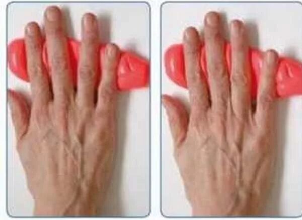 Rheumatoid Arthritis hands stock image. Image of patient - 41402001