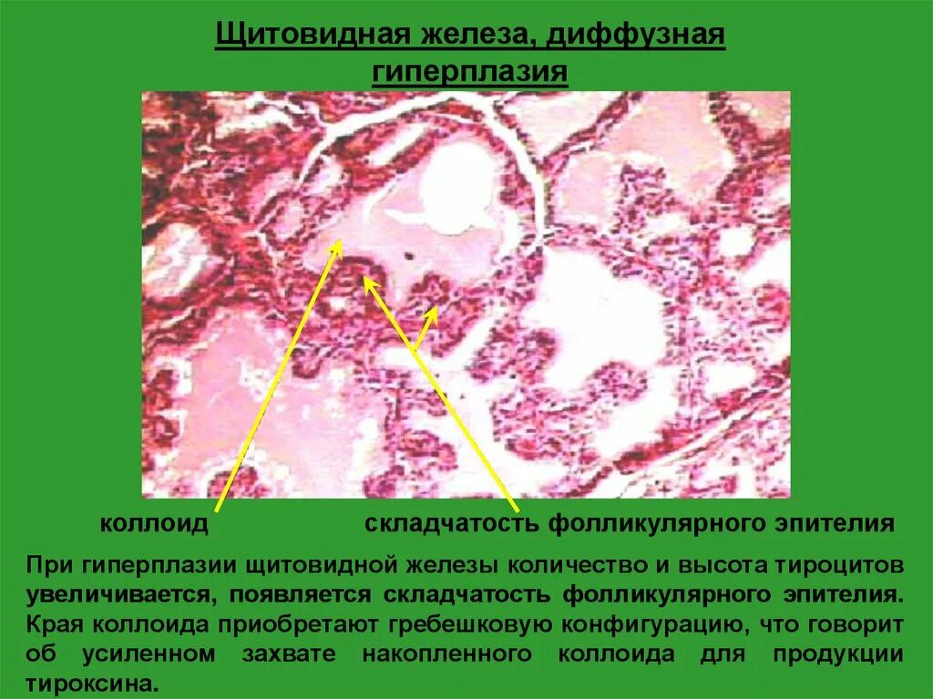 Диффузно узловая гиперплазия железы