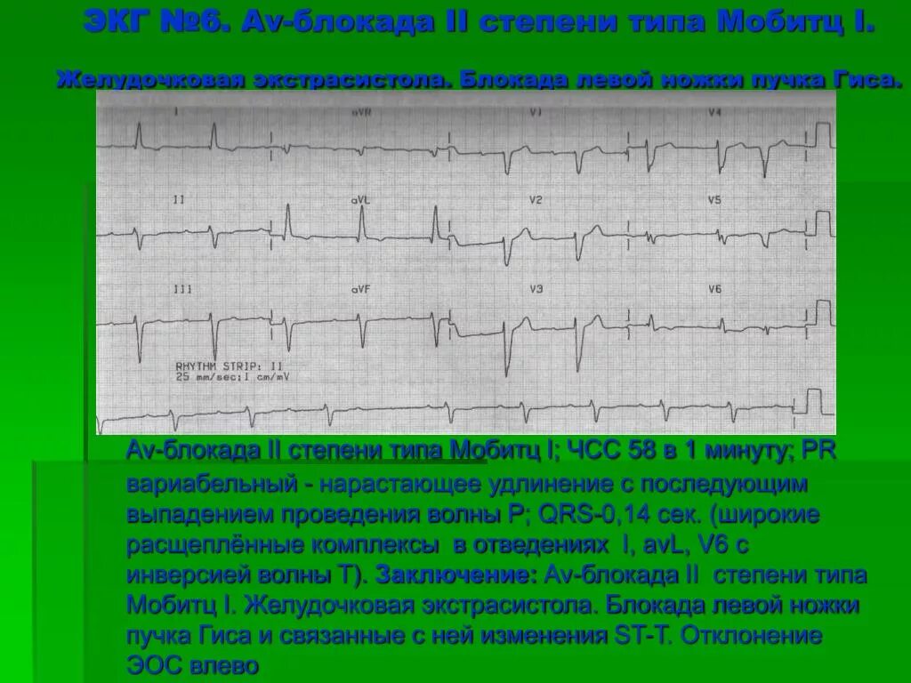 Блокада на первом. АВ блокада 2 степени 2:1 ритм. АВ блокада 1 степени при брадикардии. ЧСС при АВ блокада Мобитц 1. АВ блокада 2 степени Мобитц 1 ритм.