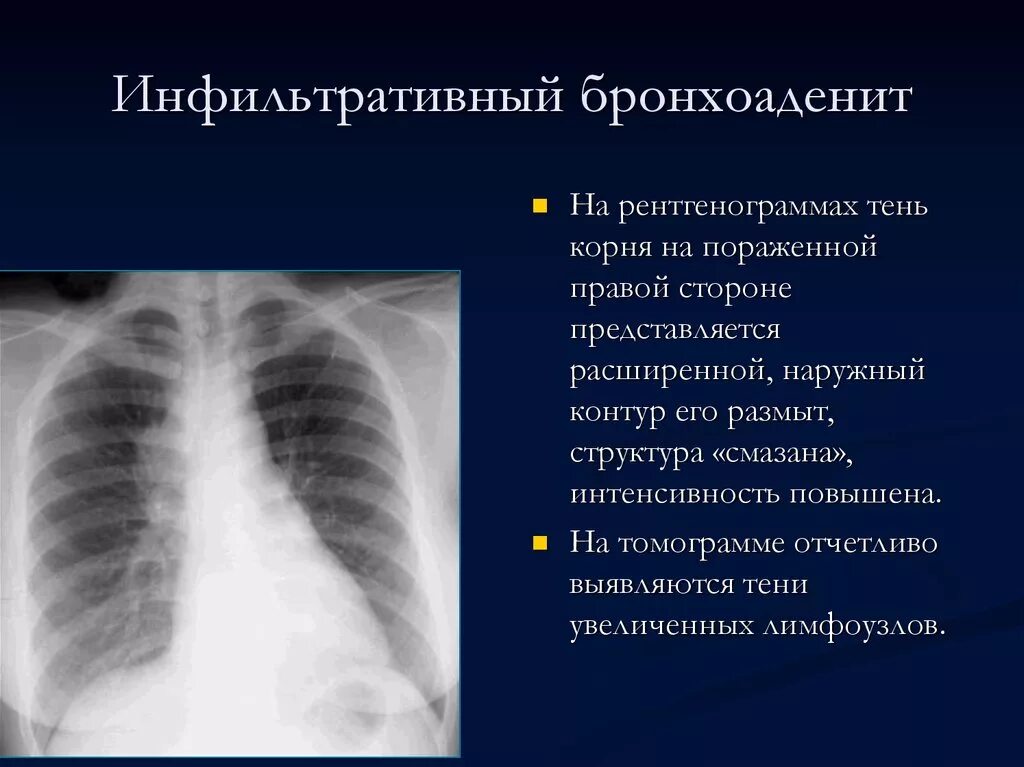 Инфильтративный туберкулез при рентгене. Инфильтративный туберкулез легких на рентгенограмме. Инфильтративный туберкулёз лёгких рентген. Туберкулезный бронхоаденит кт.