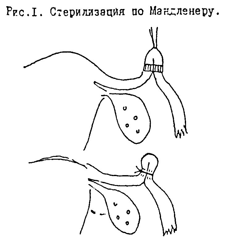 Хирургическая стерилизация по Мадленеру. Лапароскопическая операция перевязка маточных труб. Женская стерилизация (метод Помероя). Техника стерилизации Мадленера.