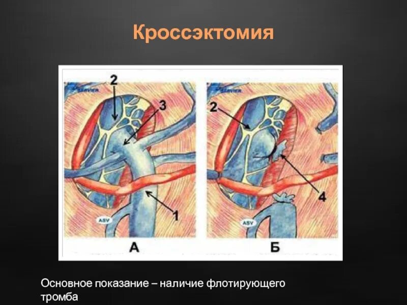Перевязка сафено-бедренного соустья. Операция троянова-тренделенбурга-дитерихса. Кросэктомия. Кросэктомия. Кроссэктомия техника операции.