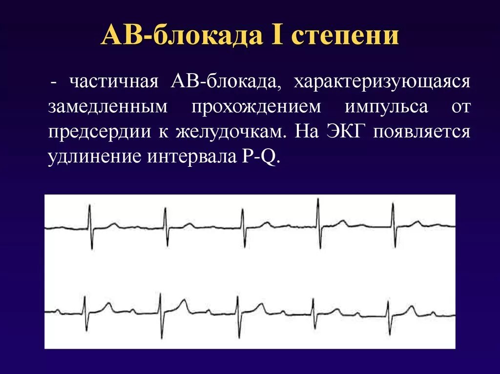 Блокада узла. АВ блокада 3 степени и 2 степени. Аб блакада 2 степени ЭКГ. Атриовентрикулярная блокада 1 степени характеризуется. АВ блокада 1-й степени ЭКГ.