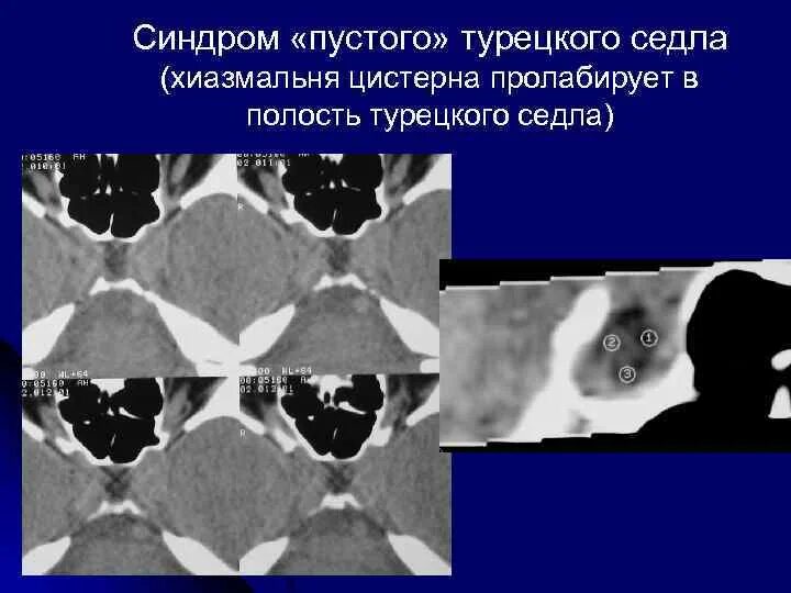 Симптом турецкого седла. Гипофиз в турецком седле. Синдром пустого турецкого седла. Синдром пустого турецкого седла кт. Пустое турецкое седло на кт.