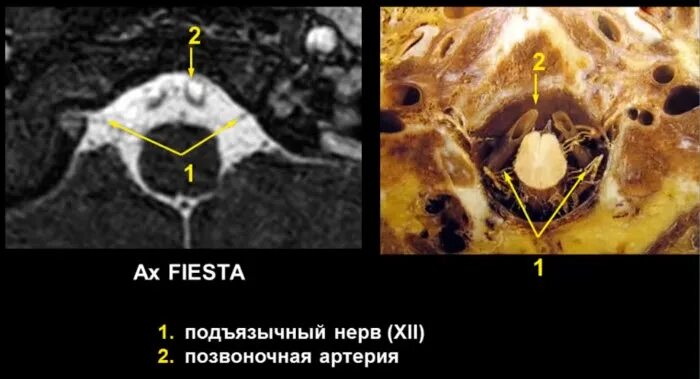 Мрт черепных нервов. Невринома слухового нерва мрт. Невринома подъязычного нерва. Невринома преддверно-улиткового нерва мрт. Невринома яремного отверстия.