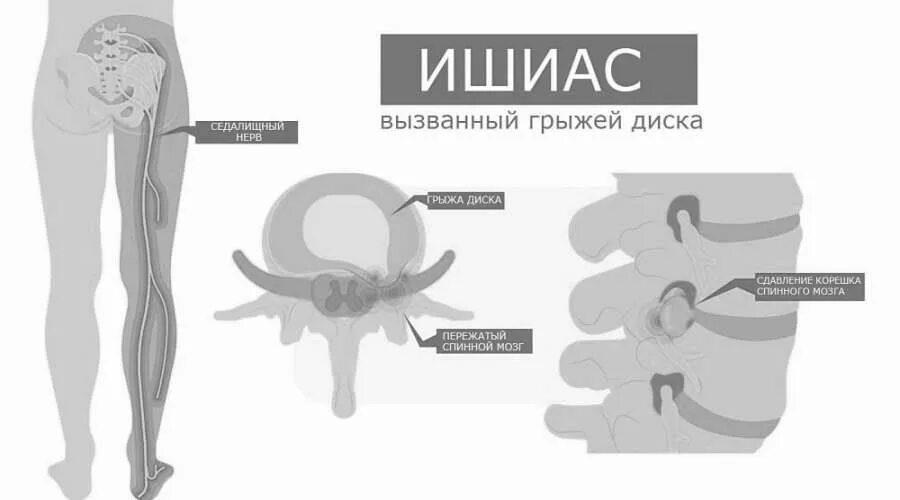 Блокада при защемлении седалищного нерва. Схема блокады седалищного нерва. Блокада при ишиасе седалищного нерва. Уколы при защемлении седалищного нерва название для блокады.