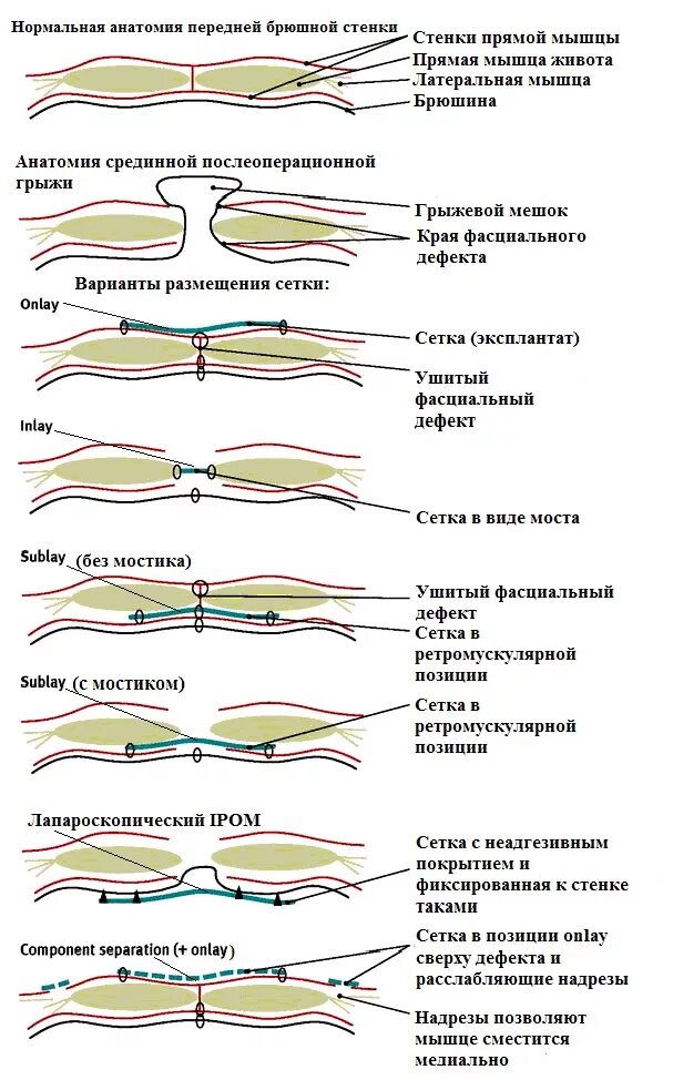 Брюшная стенка после операции. Sublay пластика грыжи. Пластика передней брюшной стенки sublay. Герниопластика onlay sublay Inlay. Классификация грыж передней брюшной стенки классификация.