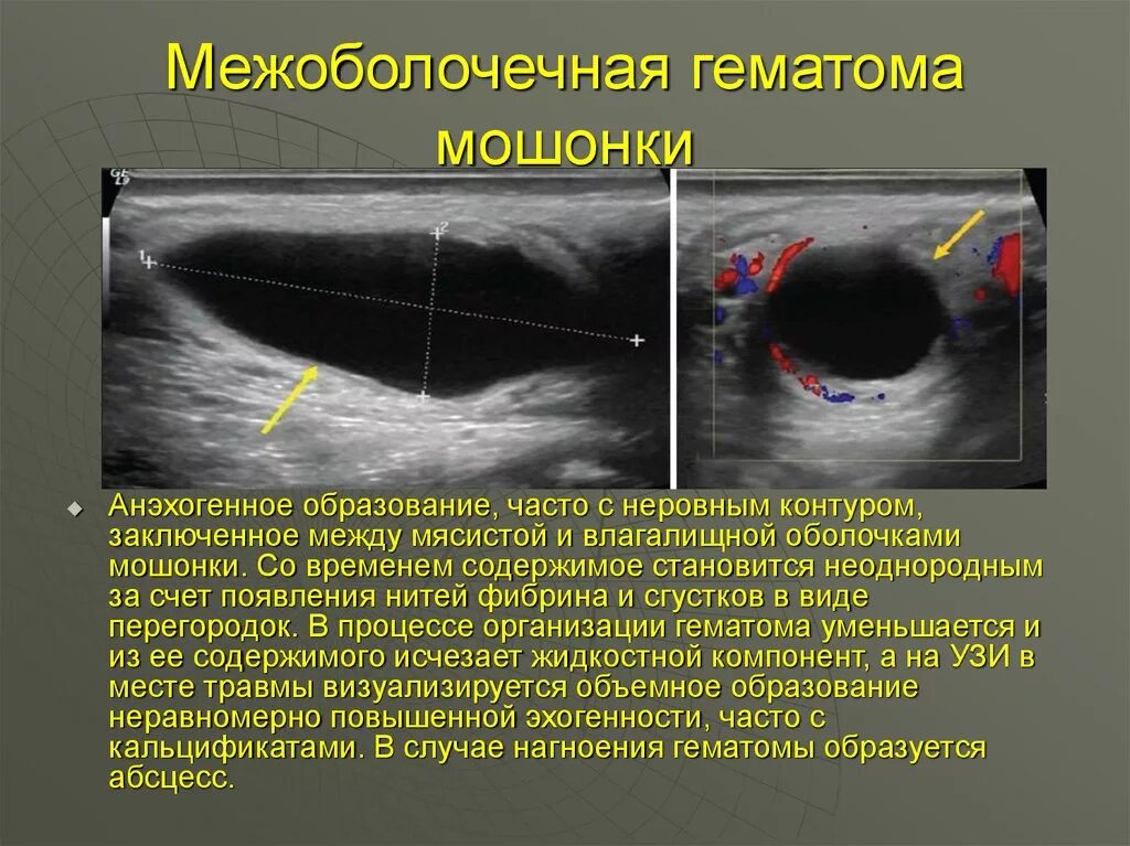 Межоболочечная гематома. Анэхогенное однородное содержимое.