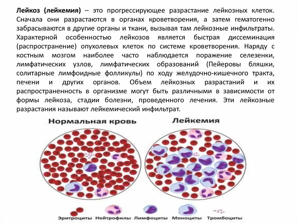 Острый лейкоз у детей симптомы. Острый лейкоз у детей симптомы