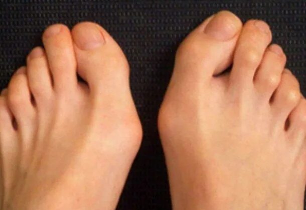 Средний палец на ноге длиннее большого. Первый палец на ноге длиннее. Первый палец на ноге длиннее. Длинные пальцы на ногп. Первый палец на ноге длиннее.