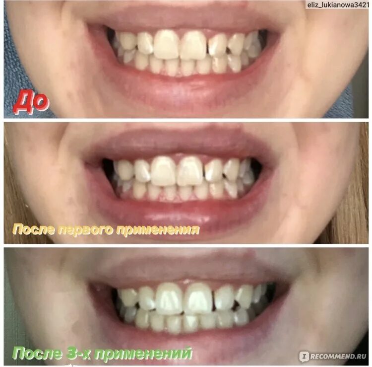 Как правильно отбеливать зубы. Как правильно отбеливать зубы