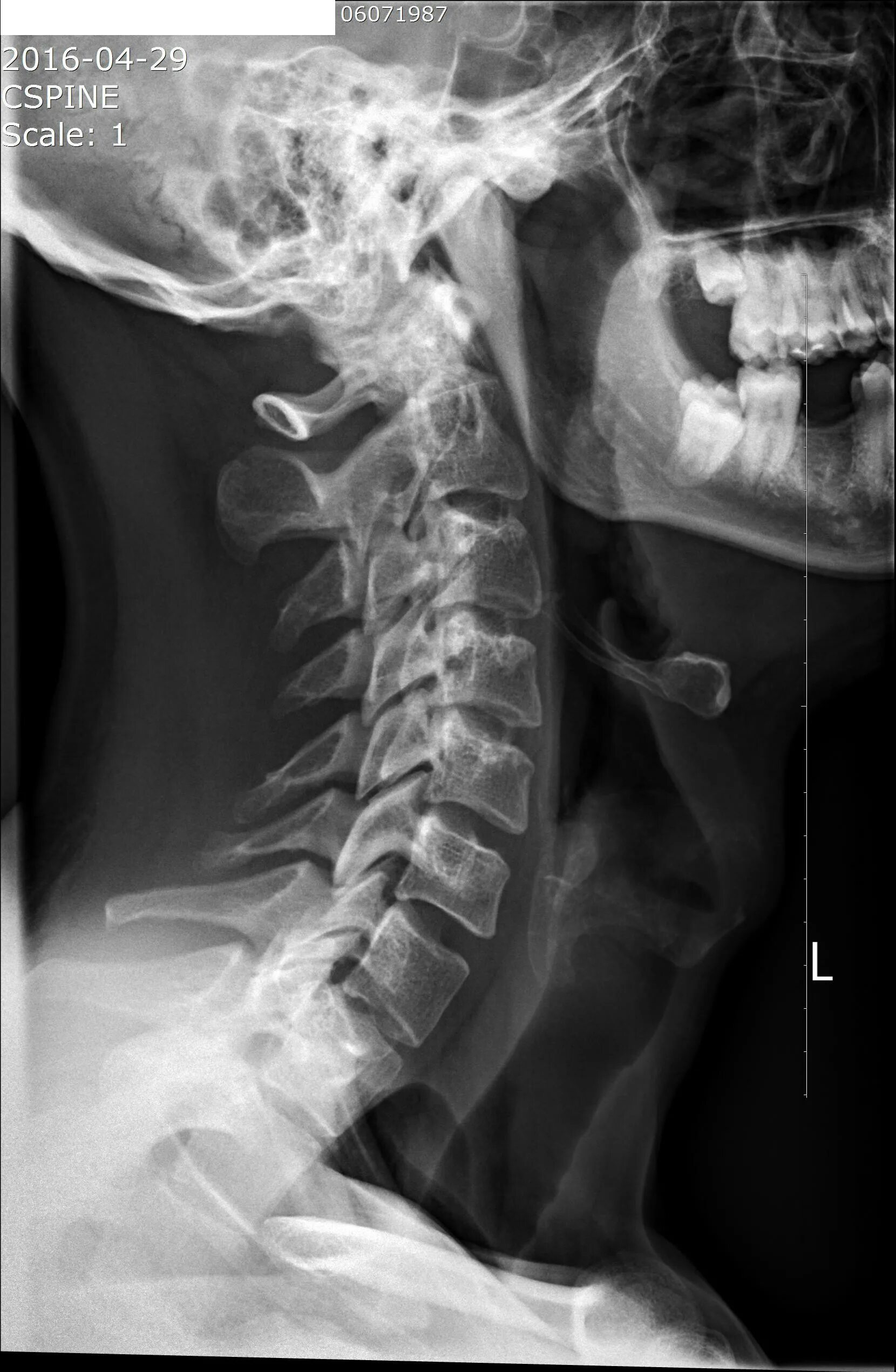 7 Шейный остеохондроз. Снимок шеи сбоку рентген. Шейные позвонки. Позвонки шейного отдела позвоночника. Остеохондроз с7
