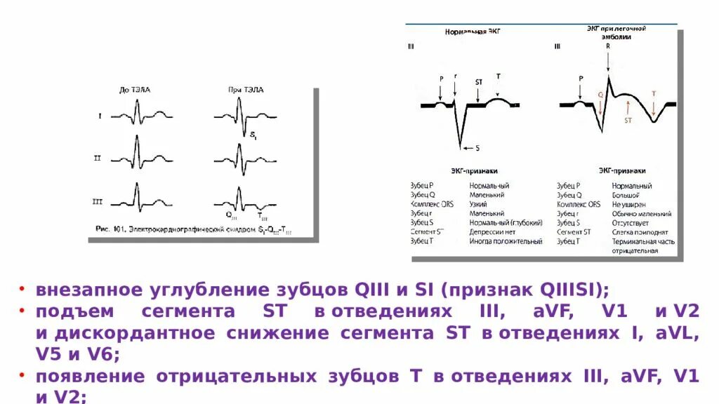 ЭКГ признаки тромбоэмболии легочной. Тромбоэмболия легочной артерии УЗИ. Тромбоэмболия на ЭКГ. ЭКГ при тромбоэмболии легочной артерии с описанием. Тромбоэмболия легочной артерии код по мкб