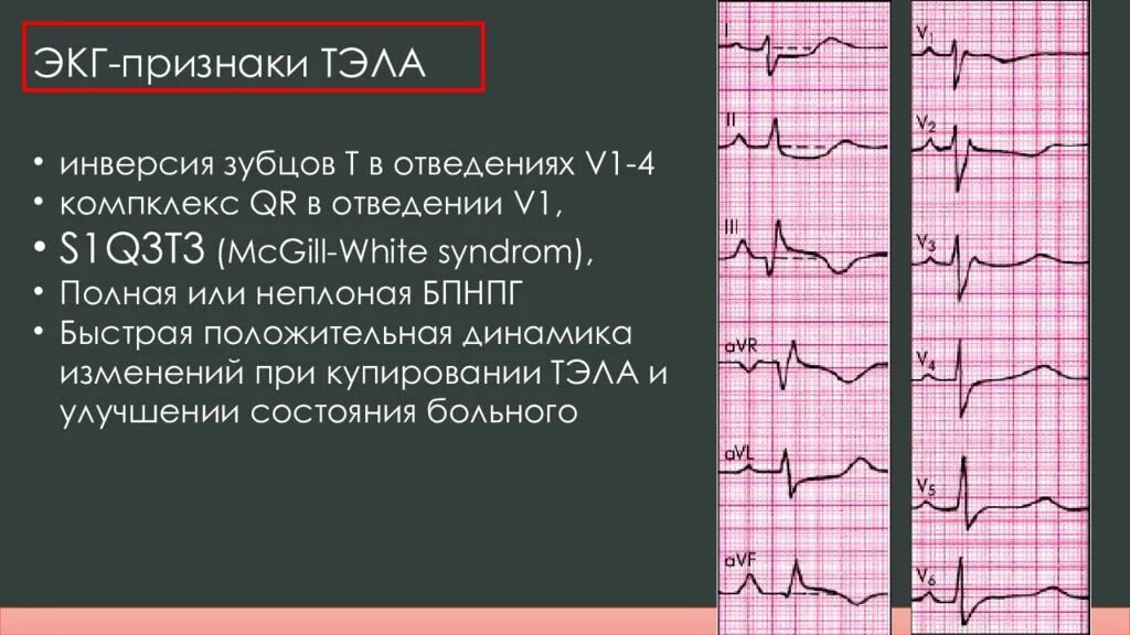 Синдром т 3. Синдром s1 q3 на экг. отрицательный зубец т на экг в v1 v2. q3 s1 тэла экг. инверсия зубца т в v4-v6.