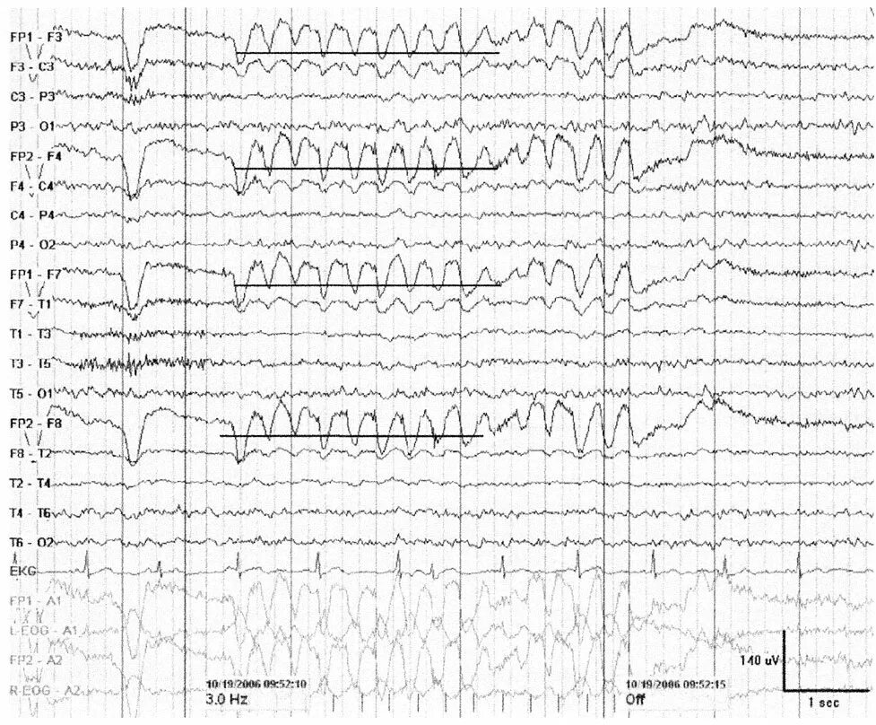 Фотостимуляция при ЭЭГ расшифровка. Субгармоники на ЭЭГ. Топокартограммы ЭЭГ. Окулограмма на ЭЭГ что это.