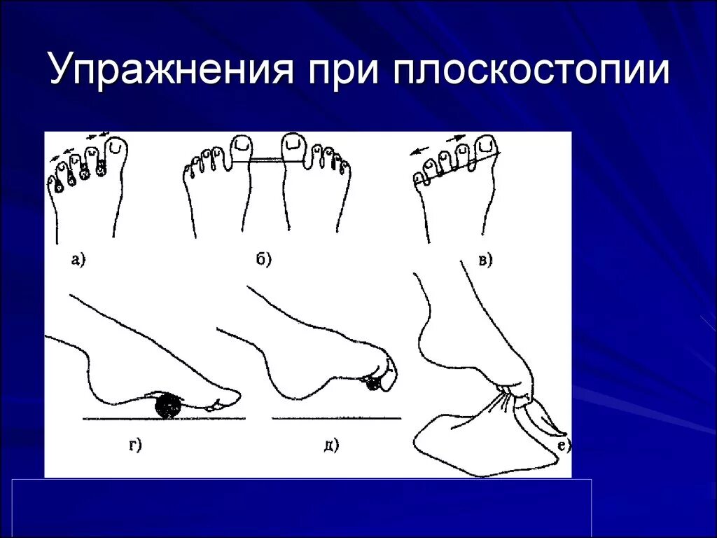 Упражнения при поперечном плоскостопии. Плоскостопие лфк комплекс упражнений. упражнения для продольного плоскостопия 2 степени. упраждкния пр пласкостопия. упражнения отп ласкостопи.