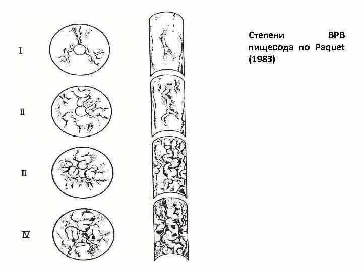 Степени варикозного расширения вен пищевода классификация. Степени варикозно расширенных вен пищевода. Варикозное расширение вен пищевода классификация по paquet. Классификация варикозно расширенных вен пищевода эндоскопическая.