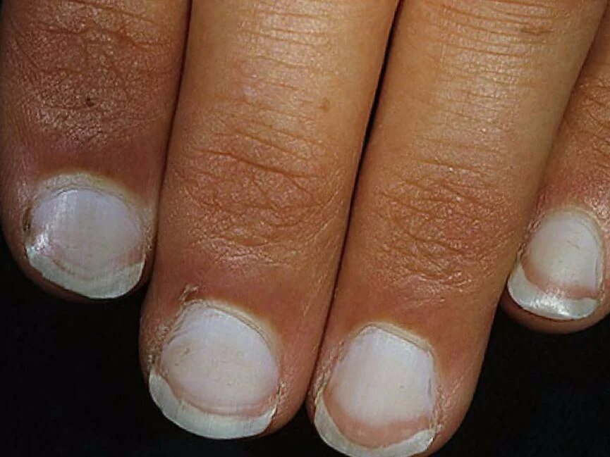 Лейконихия белые пятна на ногтях. Псориатическая лейконихия. Почему белеют ногти. Почему белеют ногти. Половинчатые ногти терри.