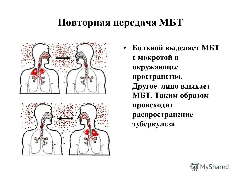 Пациент выделяет мокроту по утрам полным