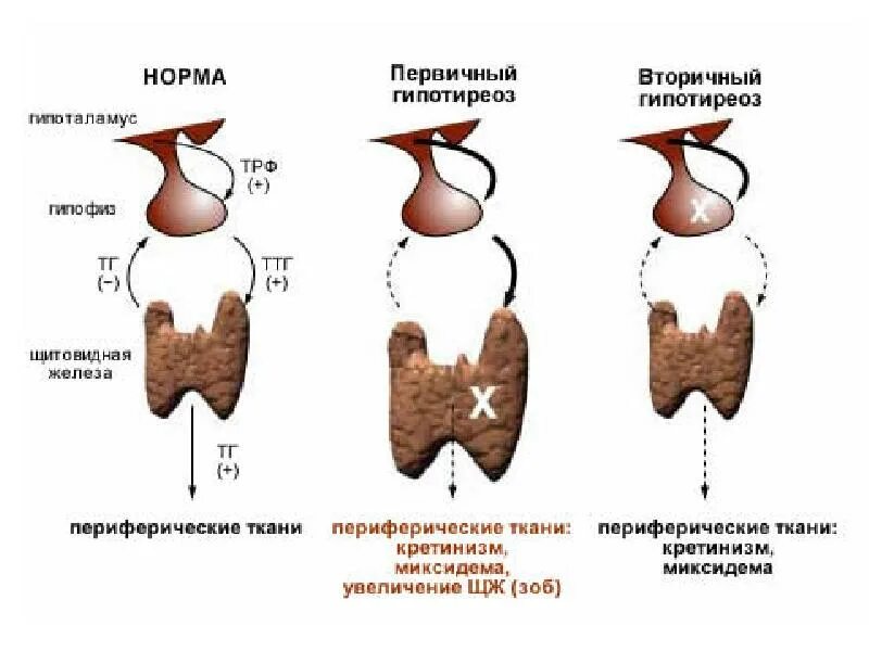 Гипотиреоз б. Первичный вторичный третичный гипотиреоз. Врожденный первичный гипотиреоз. Первичные и вторичные заболевания щитовидной железы. Врожденный гипотиреоз классификация.